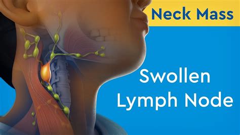 The swollen lymph node is only on the left side. . Eustachian tube dysfunction swollen lymph nodes in neck